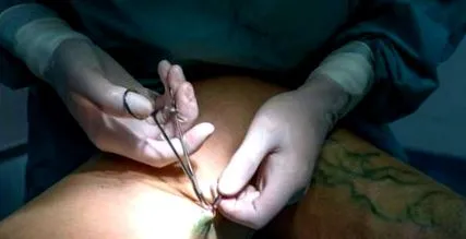 varicelor dezolarea