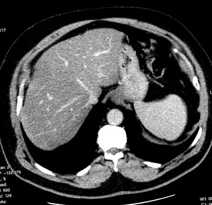 arra kérjük hogy steatosis