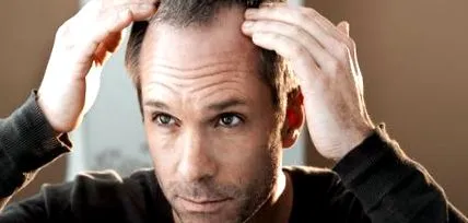 androgenetică alopecia