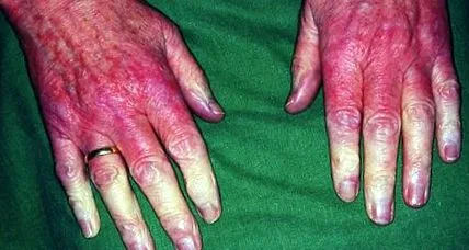 autoimmunopathia