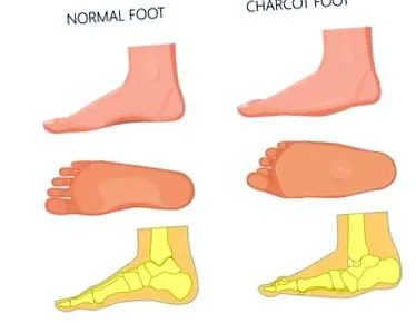 charcot tünetei