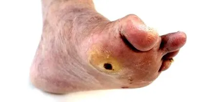 piciorului