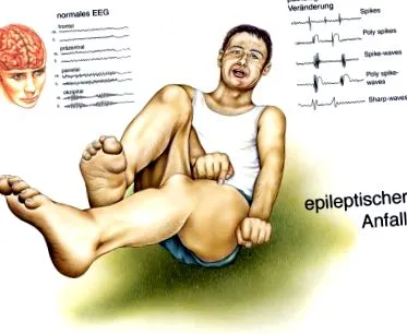 epilepsia