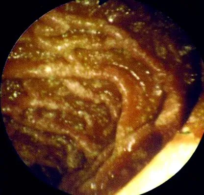 sindromul proteinelor