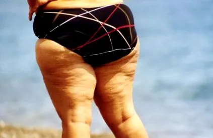 liposucția liposucția