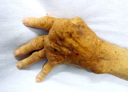 arthritis