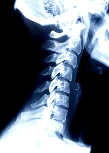 fractura