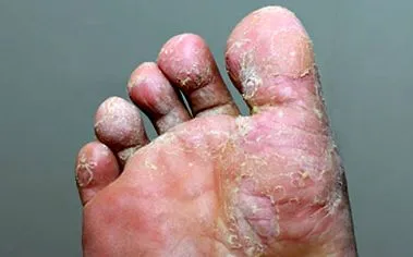 bőrgomba nagyon
