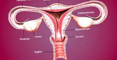 inversio uteri