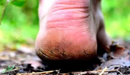hiperkeratoza