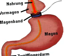 Gyomorszalag műtét