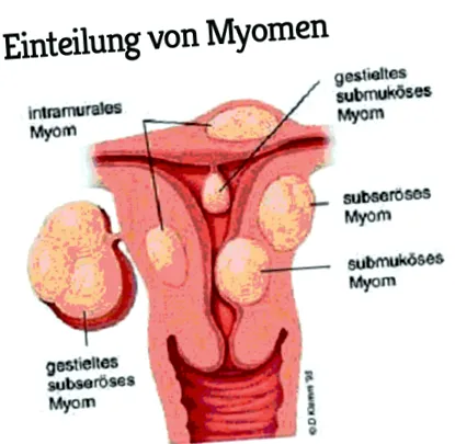 uterine-fibroame
