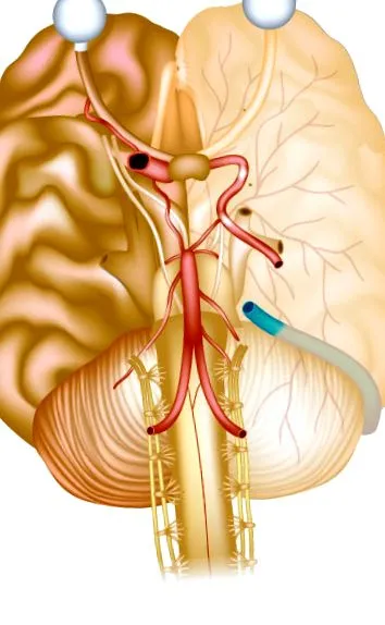 paragangliom