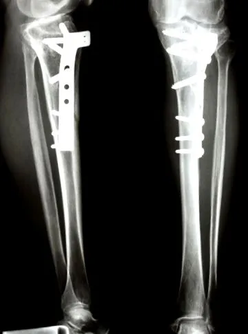 osteosinteza