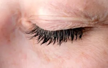 ptosis