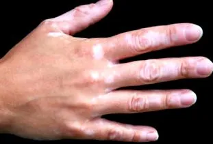 boli vitiligo