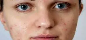 SKIN TECH