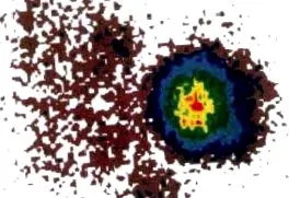adenoma