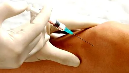 osteoartritei