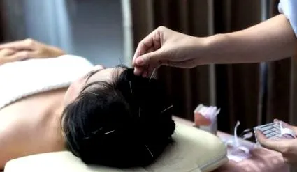 acupuncturii