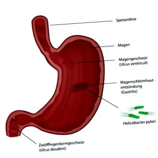 gyomorfekély nyombélfekély