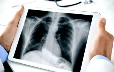 pulmonalis