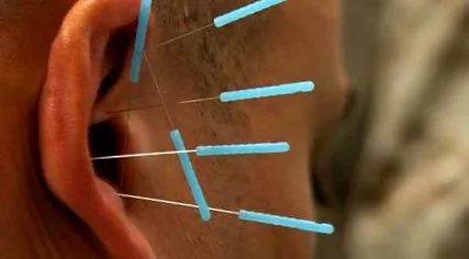acupunctura
