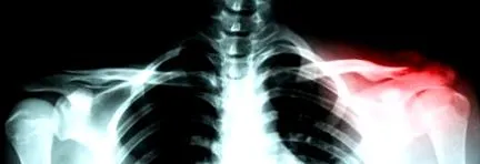 fractură claviculei