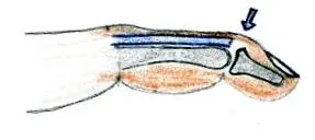 extensor