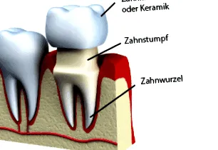 dentare