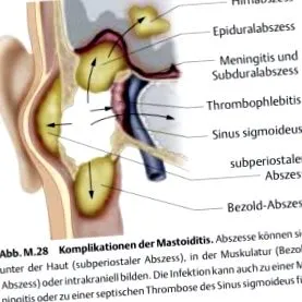 akut mastoiditis