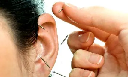 acupunctura