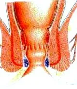 aranyér