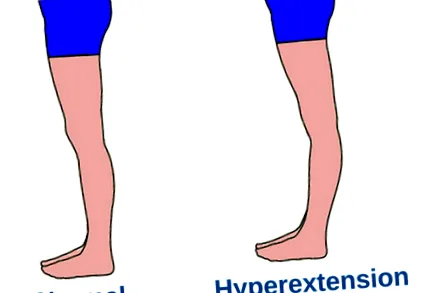 hiperextenziója