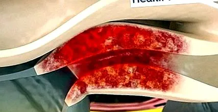 pancreatitis krónikus