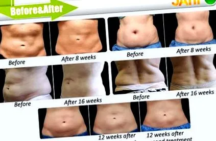 cyolipolysis