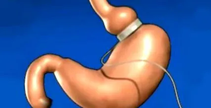 Virtual Gastric Band