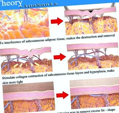 hifu liposonix