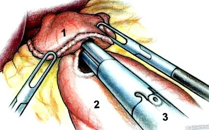 бајпас