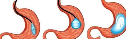 gastric
