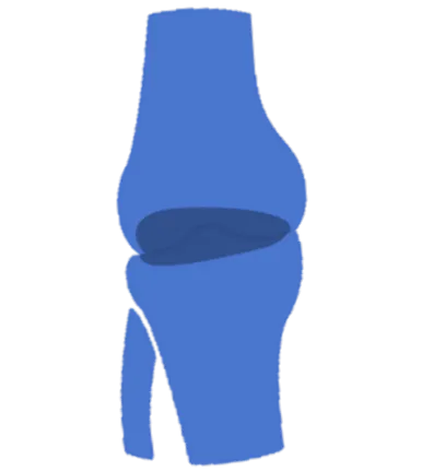 gonartrózis