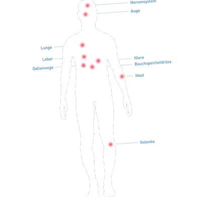 crohn-kór