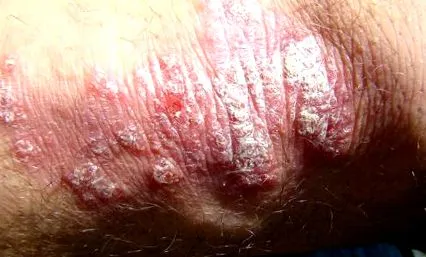 psoriázu