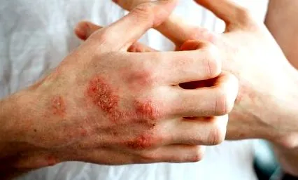 psoriáza