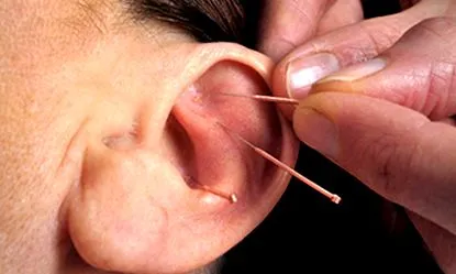 frankfurt acupunctura