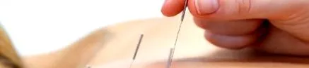 acupunctură