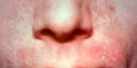 dermatitis
