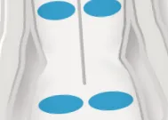 CoolSculpting® segítségével