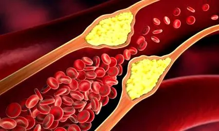 ateroscleroza