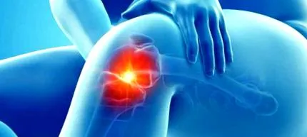 osteoartrita